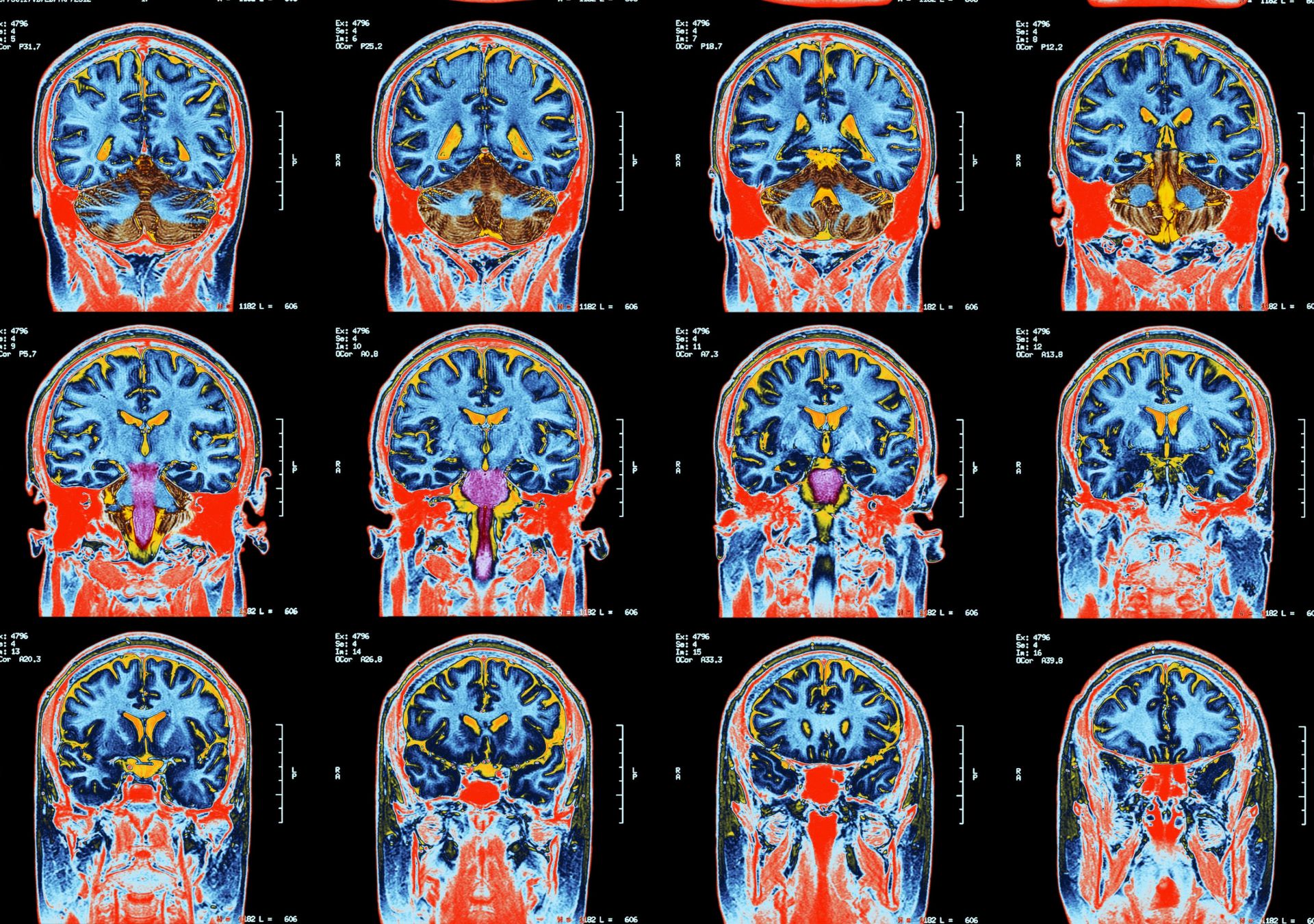 What We Now Know About Long COVID And Our Brains Pursuit By The