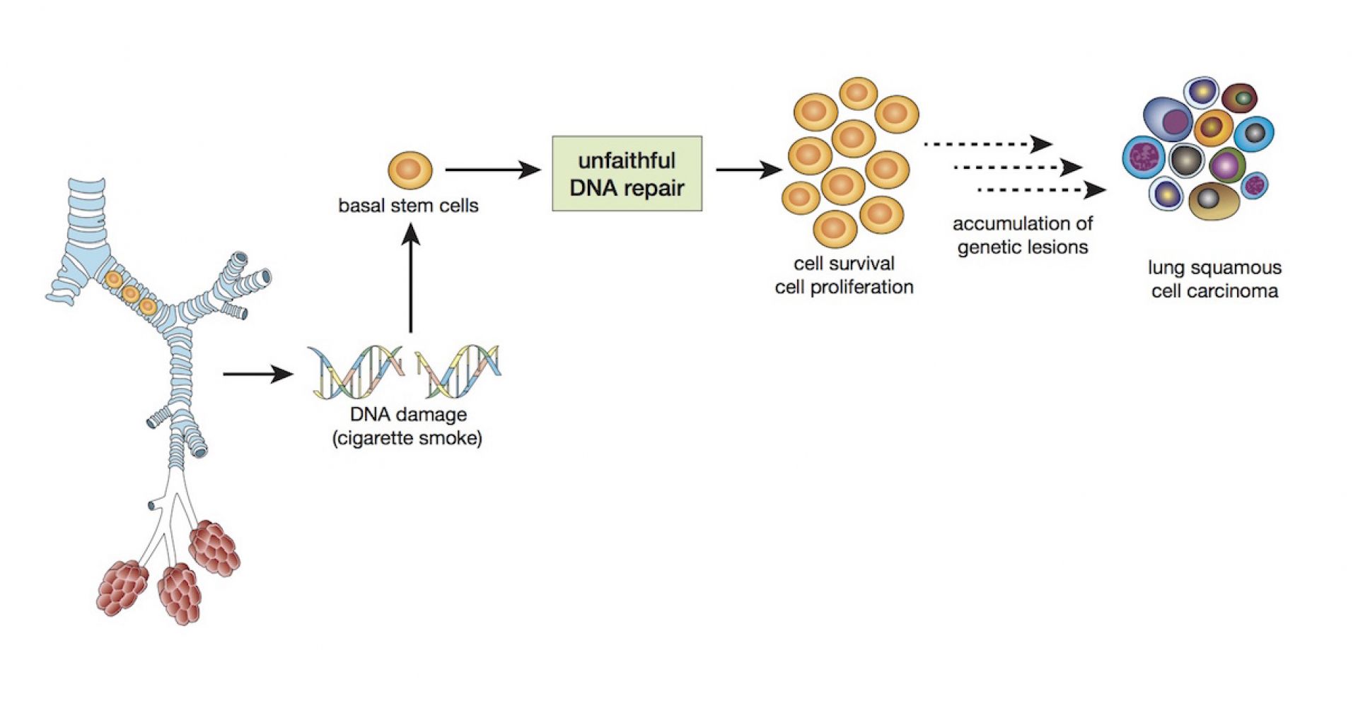 Caught! The cell behind a lung cancer | Pursuit by the University of ...