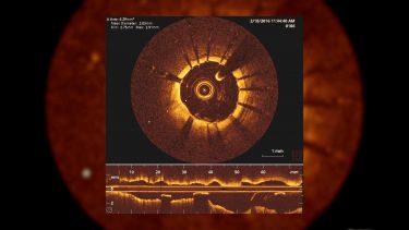 Using maths to assess blocked arteries thumbnail image