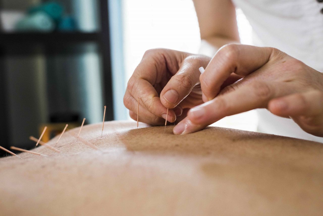 Acupuncture can treat hot flushes, but there’s a catch thumbnail image