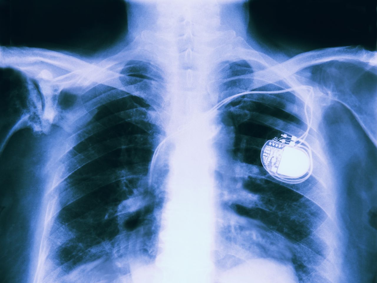 Part human, part robot: The future of medical implantables thumbnail image