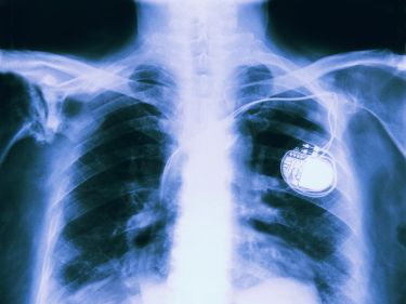 Part human, part robot: The future of medical implantables thumbnail image