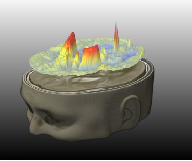 ‘Rusty’ brains linked to Alzheimer’s thumbnail image