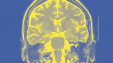 Breakthrough: Medicinal cannabis and severe epilepsy thumbnail image