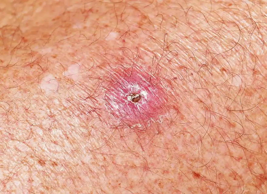 A close-up of a Buruli ulcer scar