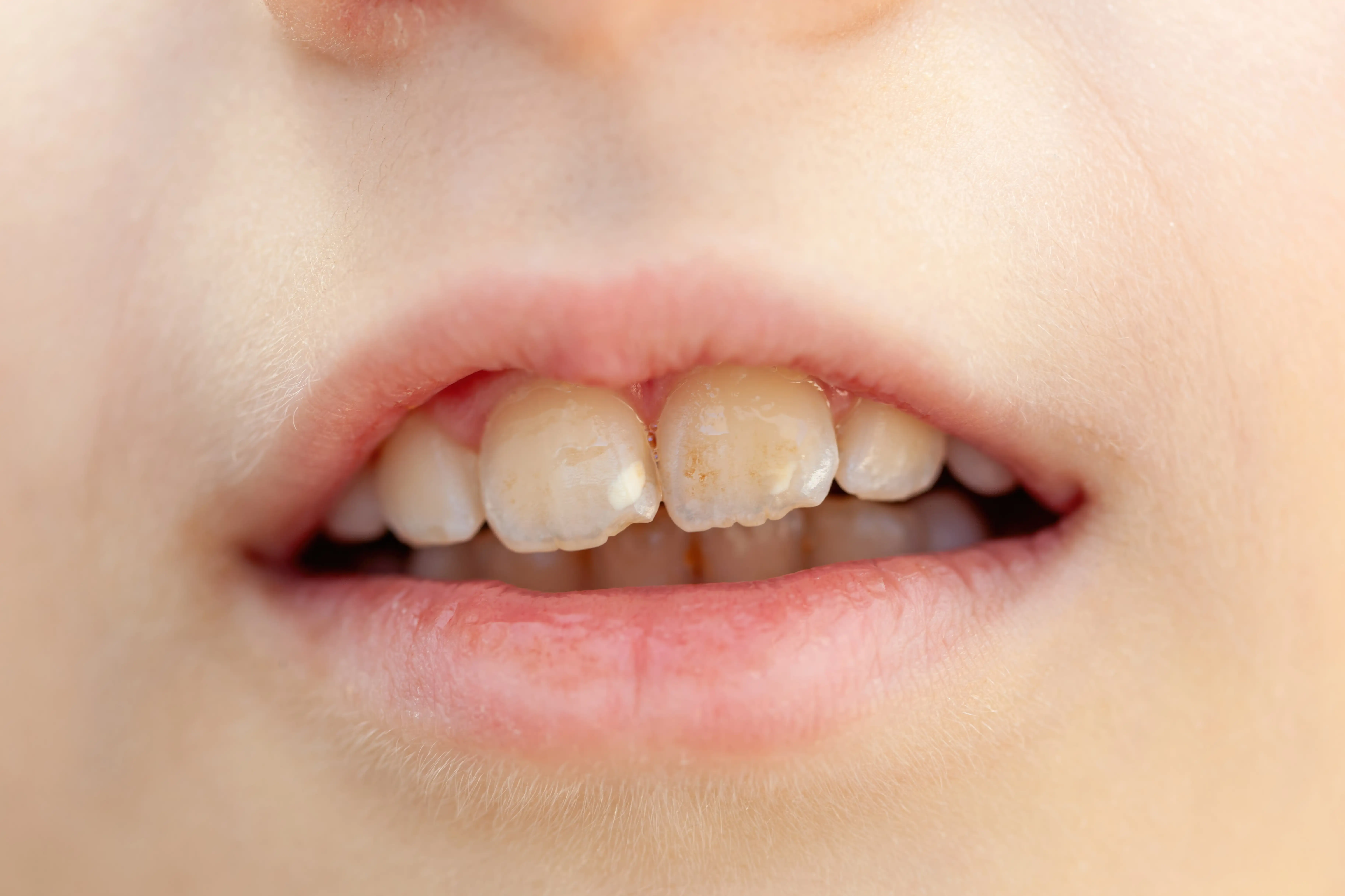 Close up of a child's mouth showing hypomineralization of teeth, a common dental defect affecting the enamel of permanent first molars and incisors, making them more susceptible to decay
