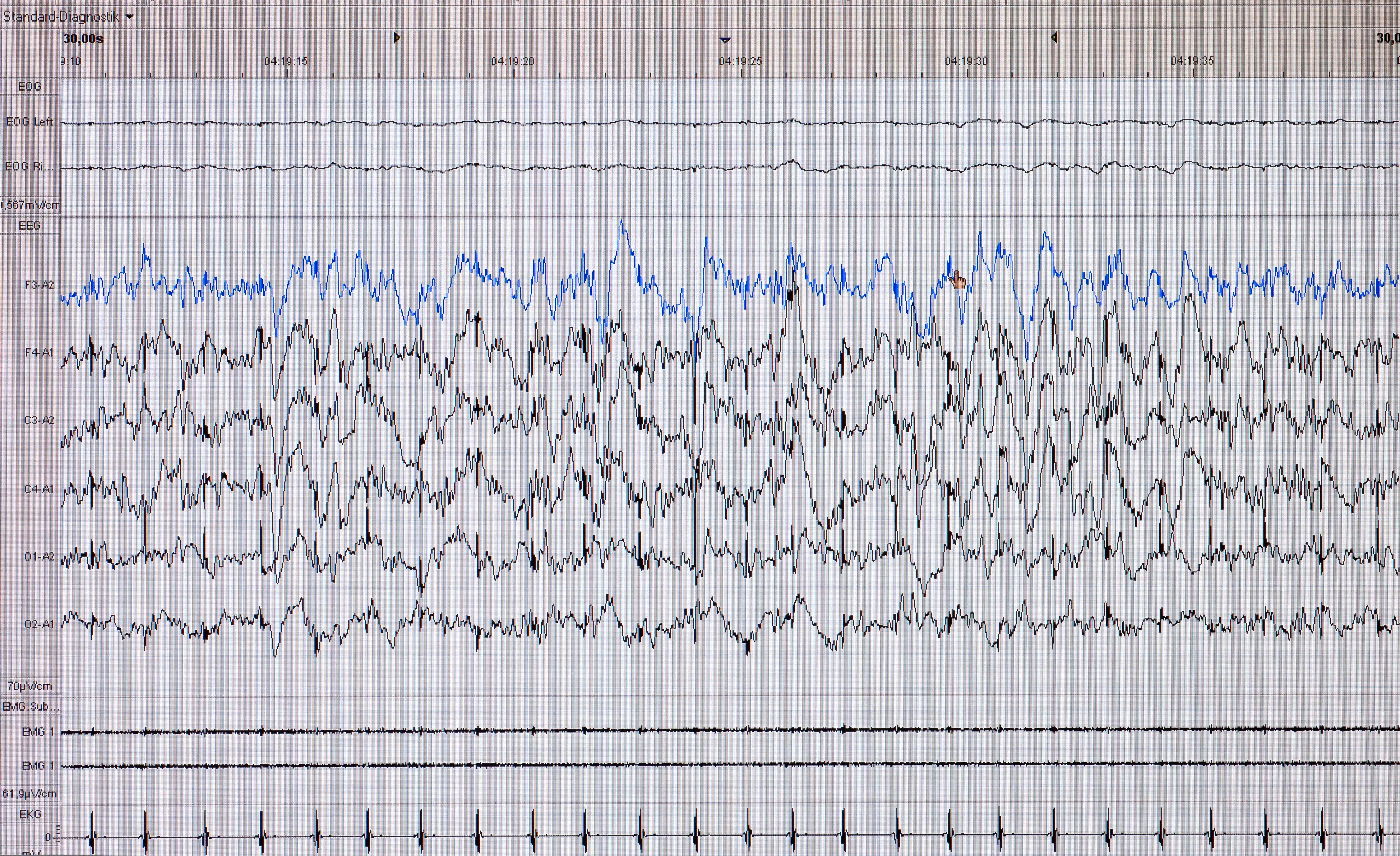 A polysomnography read out on a computer screen