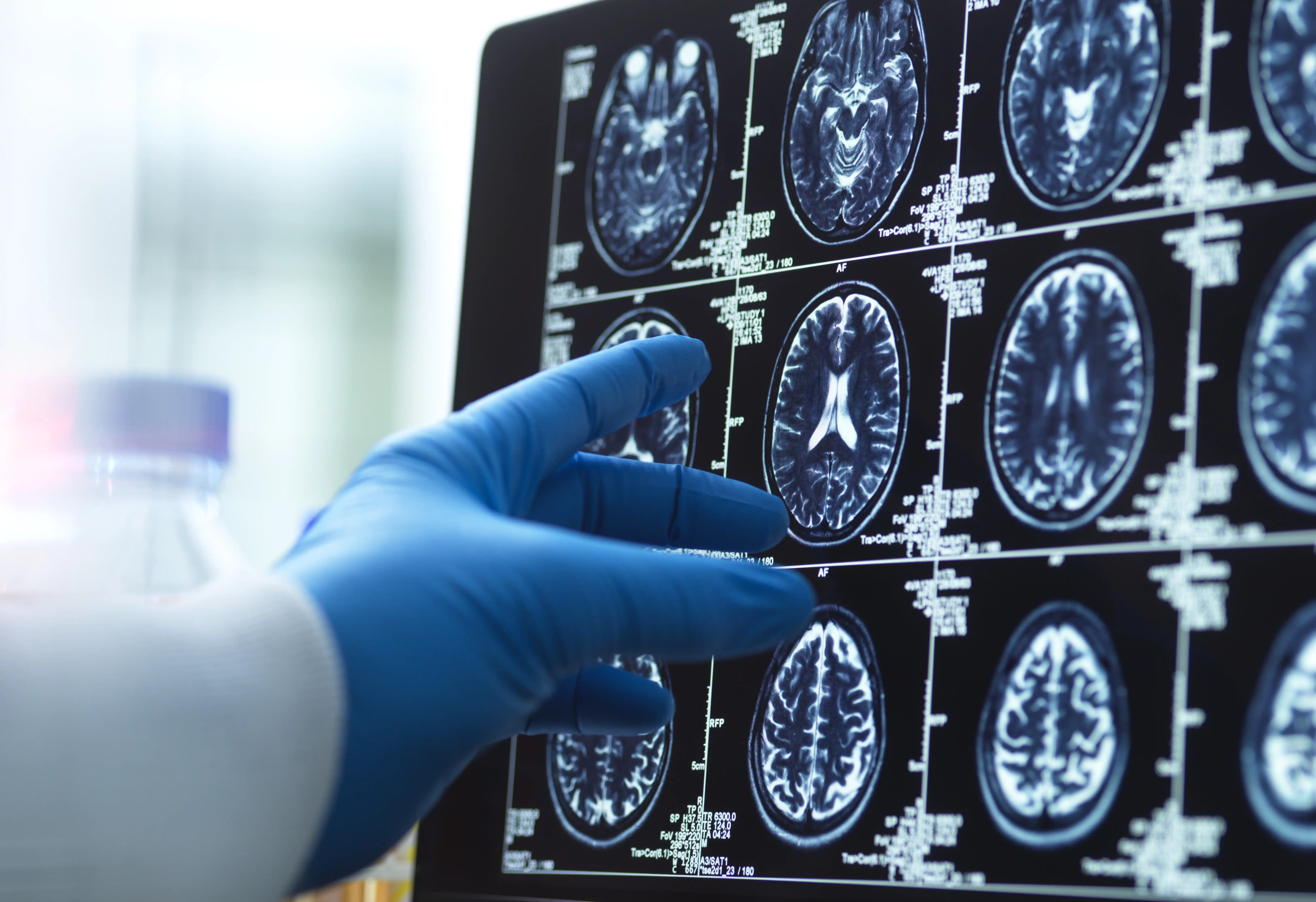 A gloved hand points at brain scans on a screen