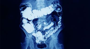 What's gone wrong with managing bowel cancer in Australia? thumbnail image