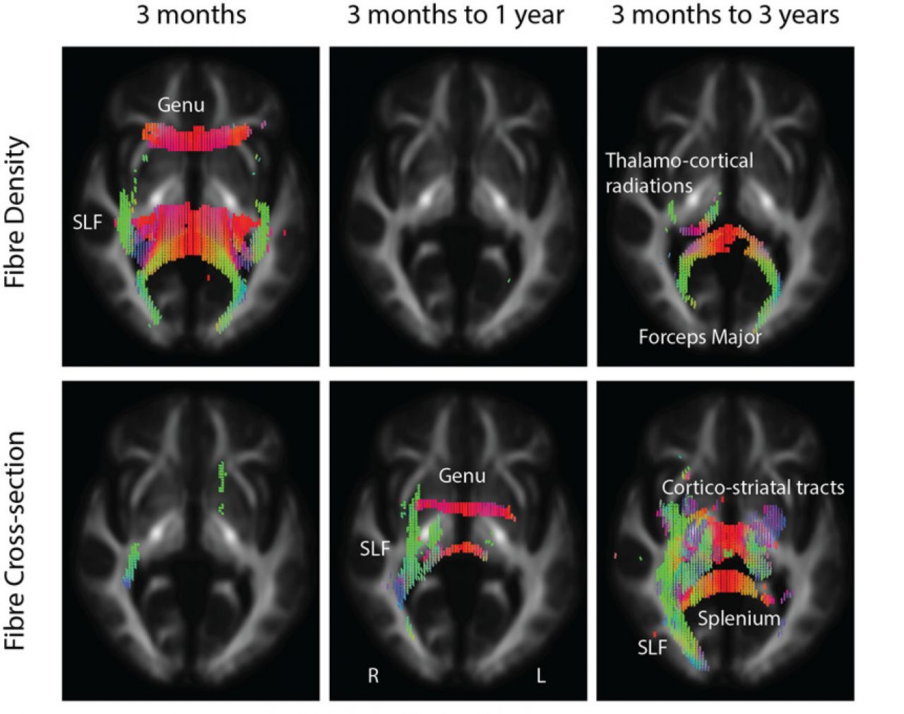 Brain white matter declines for years after a stroke | Pursuit by the ...