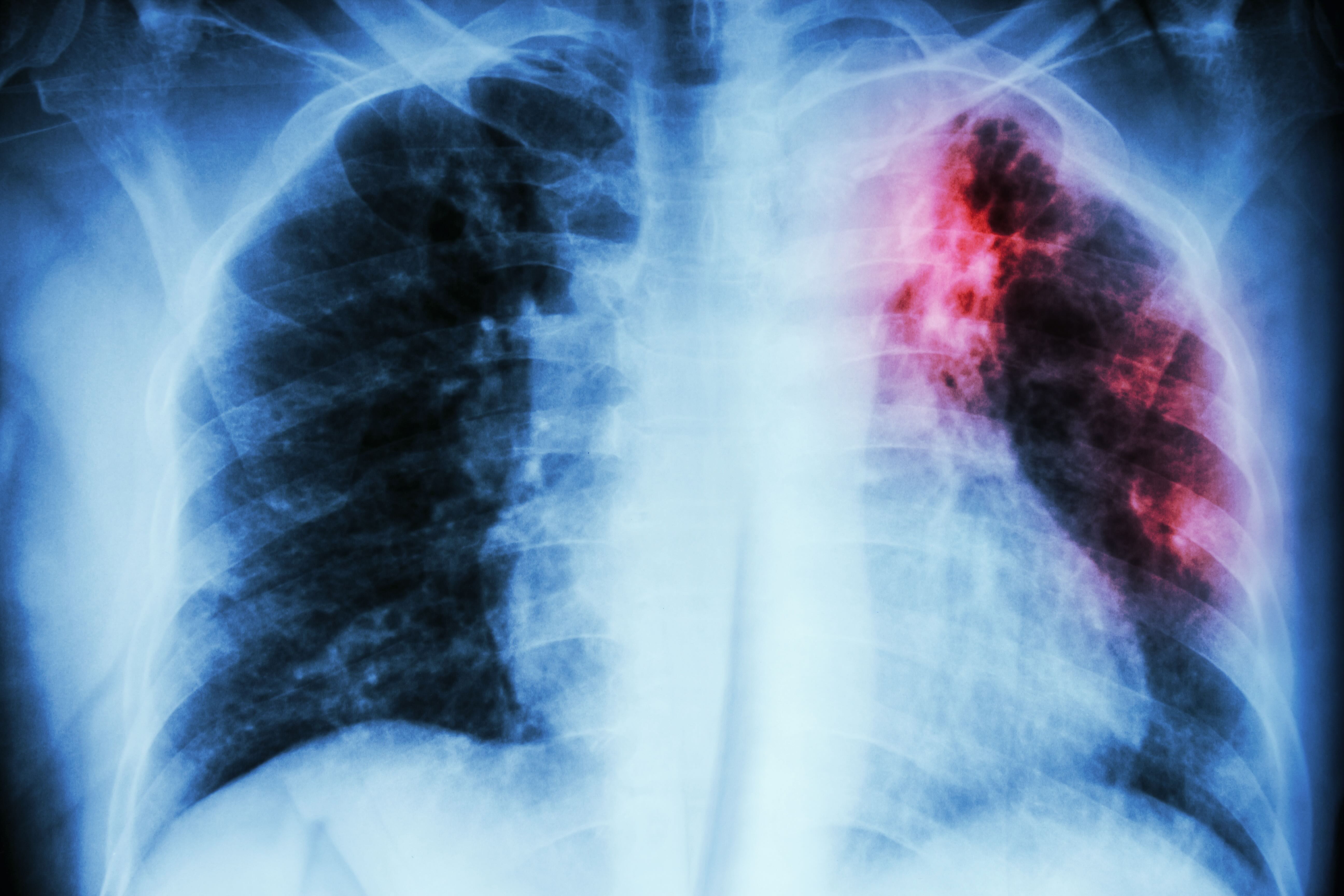 Tuberculosis on x-ray