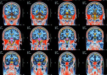 What we now know about long COVID and our brains thumbnail image