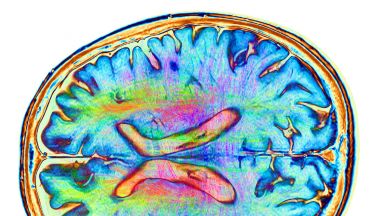 Brain development is altered in people at high risk of psychosis thumbnail image