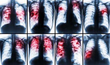 From decades to days: 3D modelling tuberculosis thumbnail image