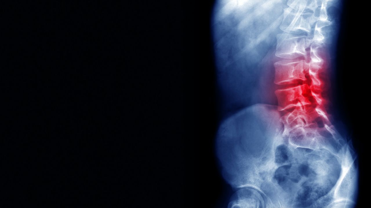 Predicting risk of spinal fracture using bioengineering thumbnail image