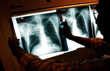 Tuberculosis: Still a major killer thumbnail image