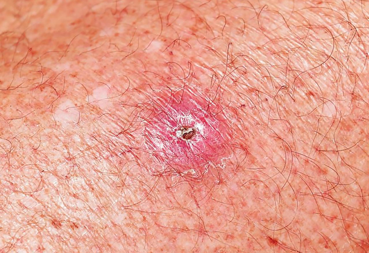 Australia’s flesh-eating bug outbreak needs urgent research thumbnail image